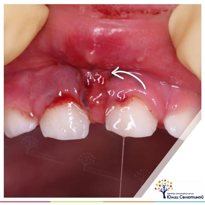 Ребёнок рассёк уздечку: что делать? 