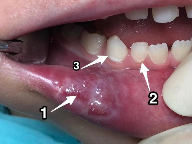 Травма губы.