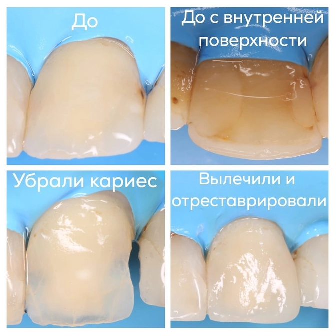 Профилактика контактного кариеса 