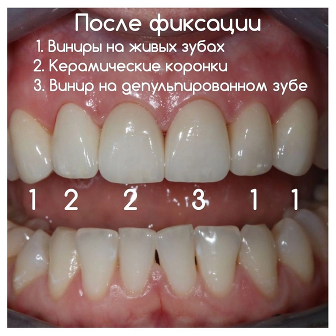 Виниры: показания и противопоказания.