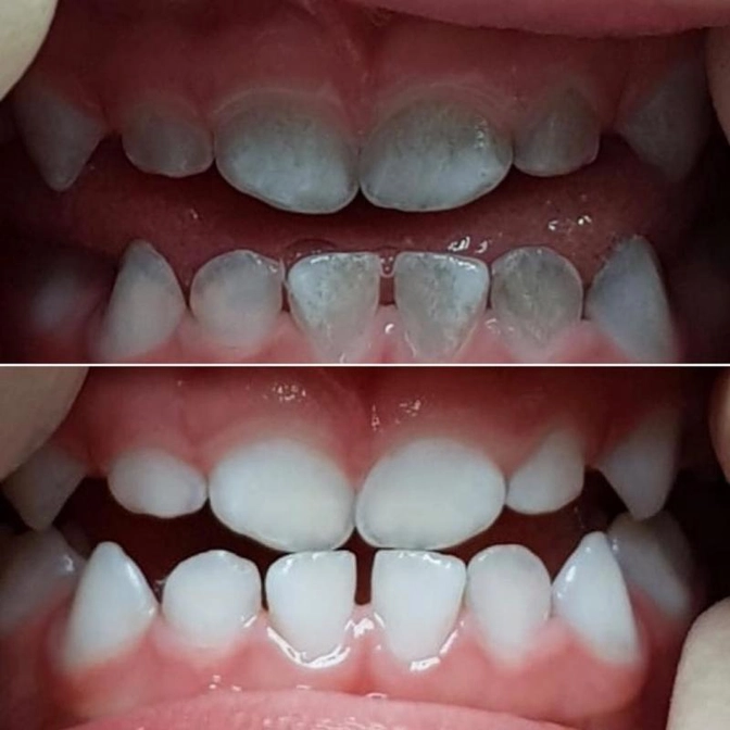 Пигментированный налёт. Клинический случай.