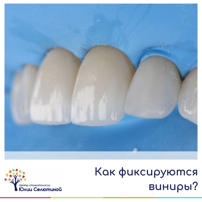 Как фиксируются виниры?