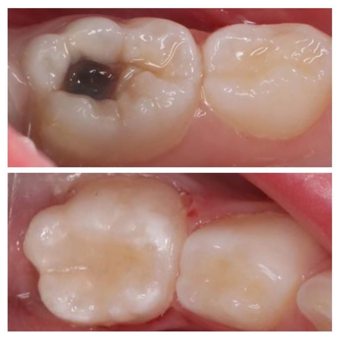 Лечение кариеса молочного зуба