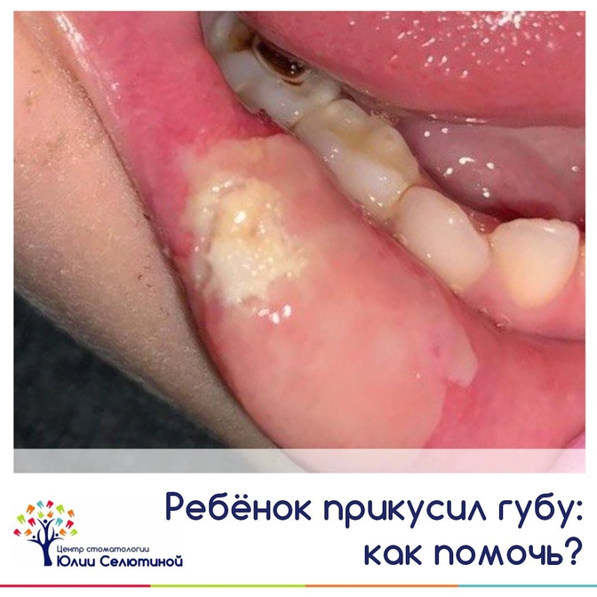 Ребенок прикусил губу: чем помочь?