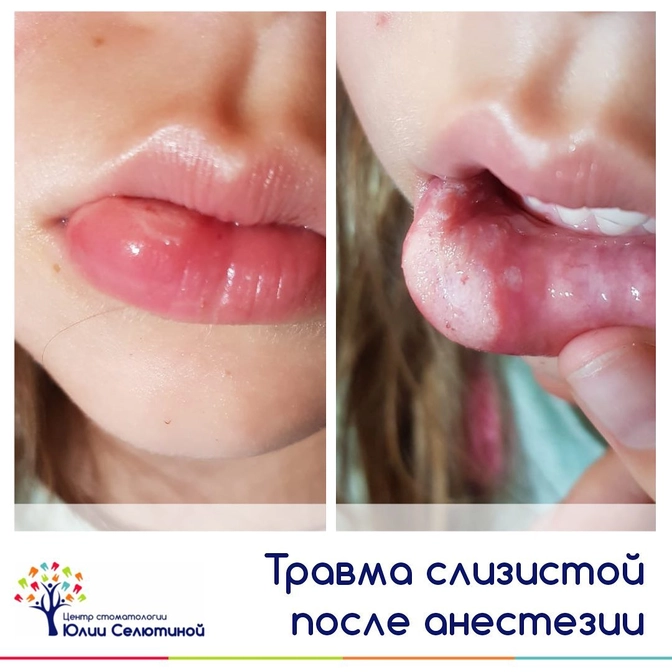 Травма слизистой оболочки после местной анестезии.