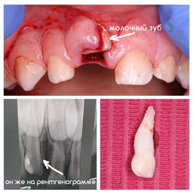 Вколоченный вывих зуба: можно ли спасти зуб?