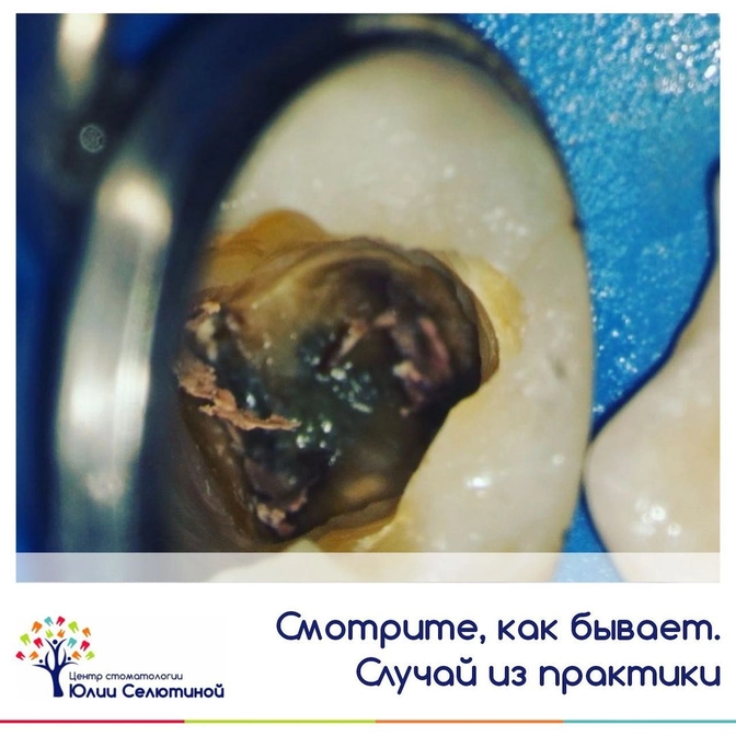 Ревизия зуба: подготовка зуба к протезированию 