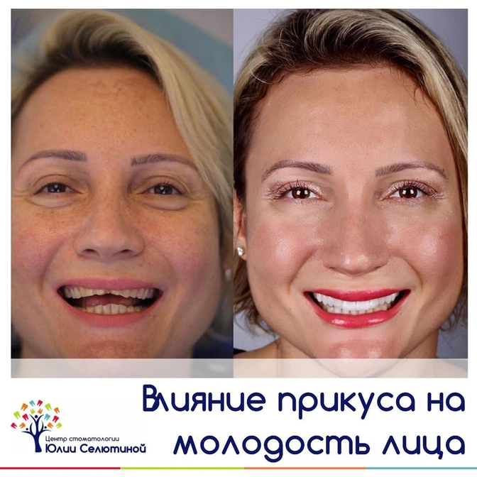 Как связаны прикус и молодость лица?