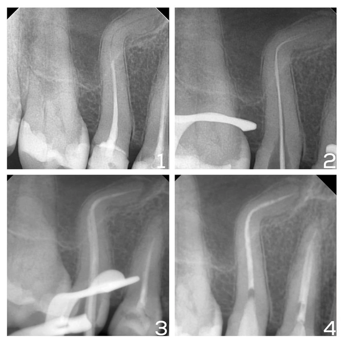 Лечение сильно изогнутого канала 
