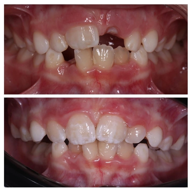 Если челюсти ребенка слишком узкие...