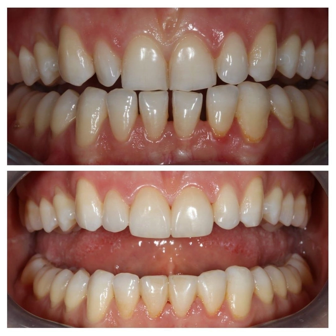 Коррекция улыбки винирами 