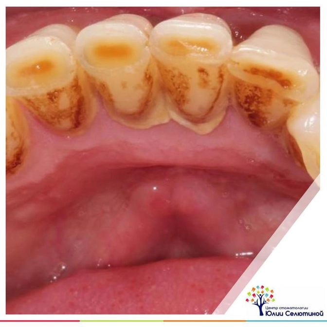 Налет и зубной камень - в чем разница?