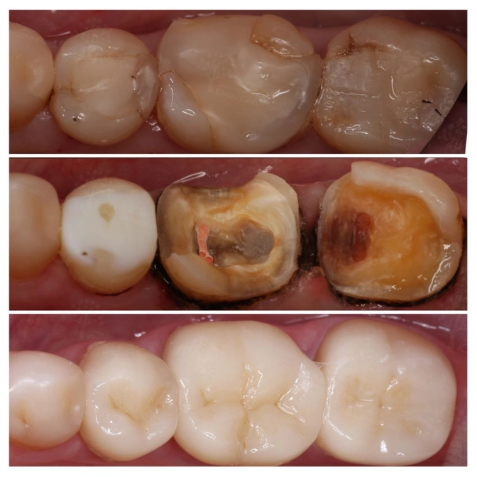 Замена старых пломб на трёх зубах