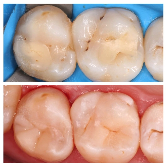 Клинический случай: замена старых пломб на новые