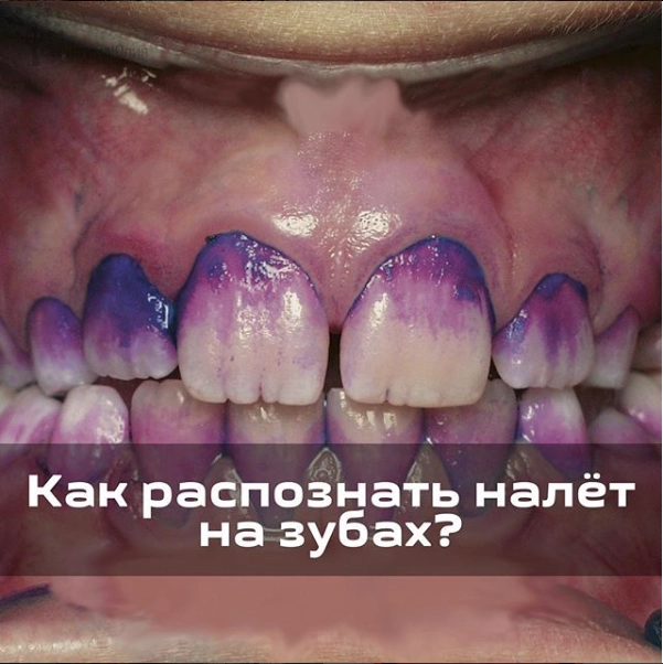 Как распознать налет за зубах