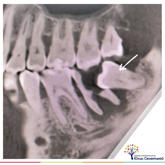 Как "восьмерка" вредит соседнему зубу?