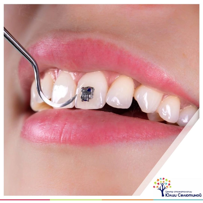 Почему я выбрала брекеты, а не элайнеры