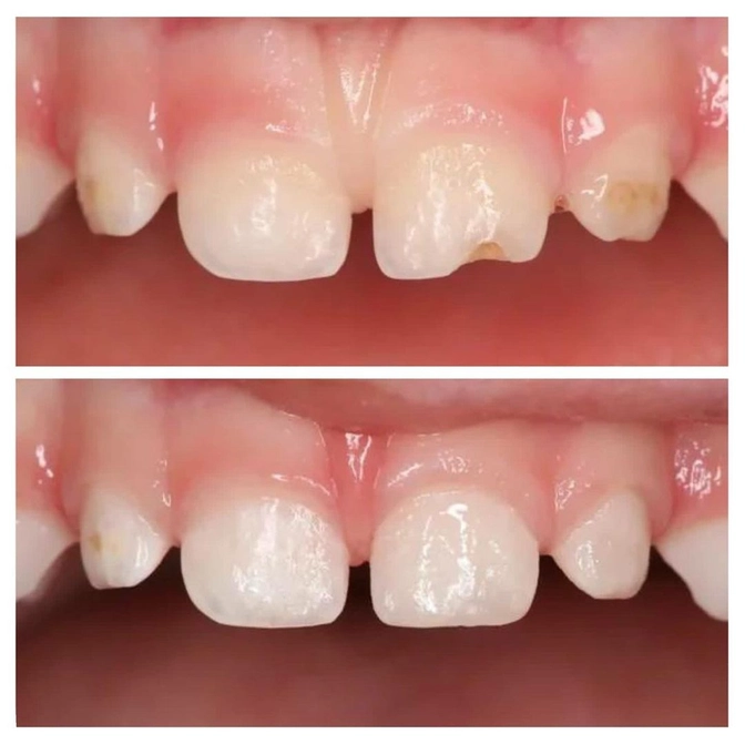 Лечение кариеса у малыша без наркоза 