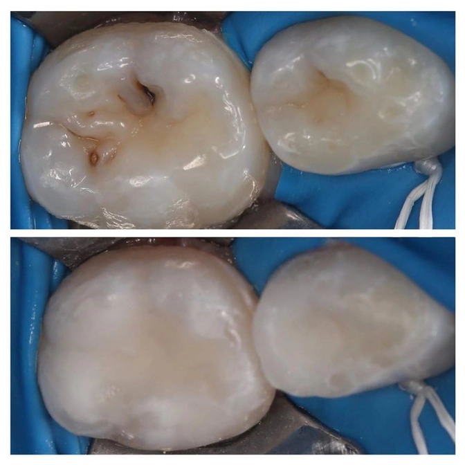 Лечение контактного кариеса молочных зубов