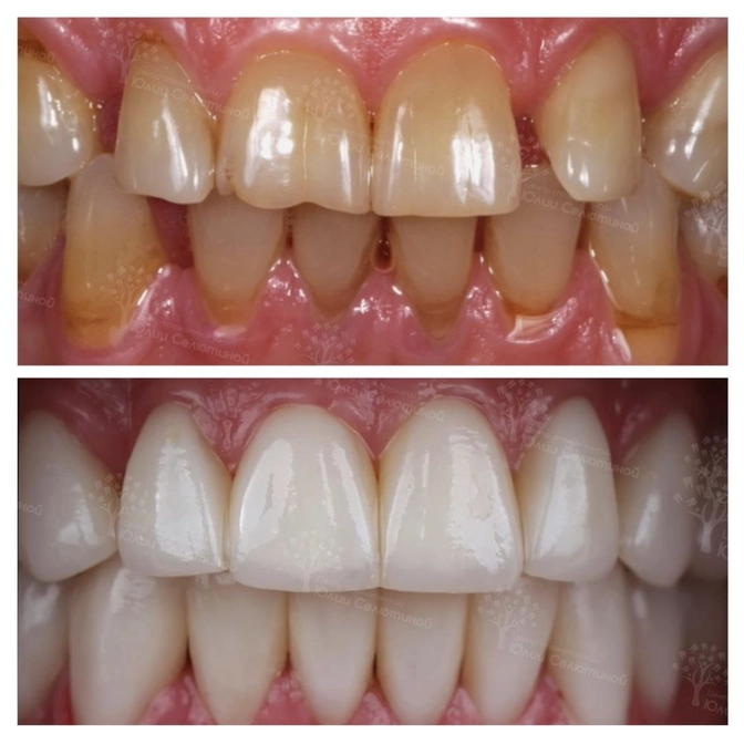 Тотальное преображение улыбки 