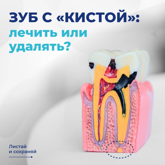 Зуб с «кистой»: лечить или удалять?