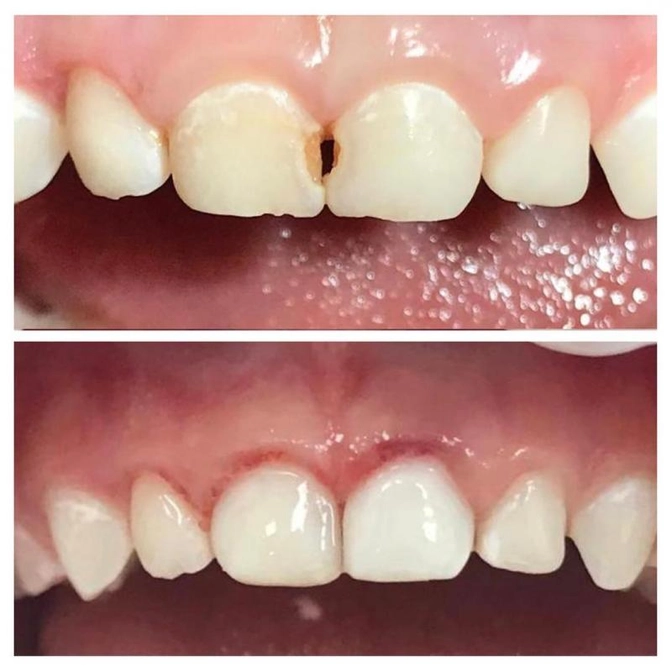 Лечение кариеса центральных молочных зубов.