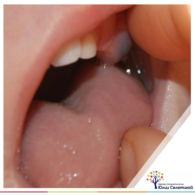 Что такое "глазные зубы"?