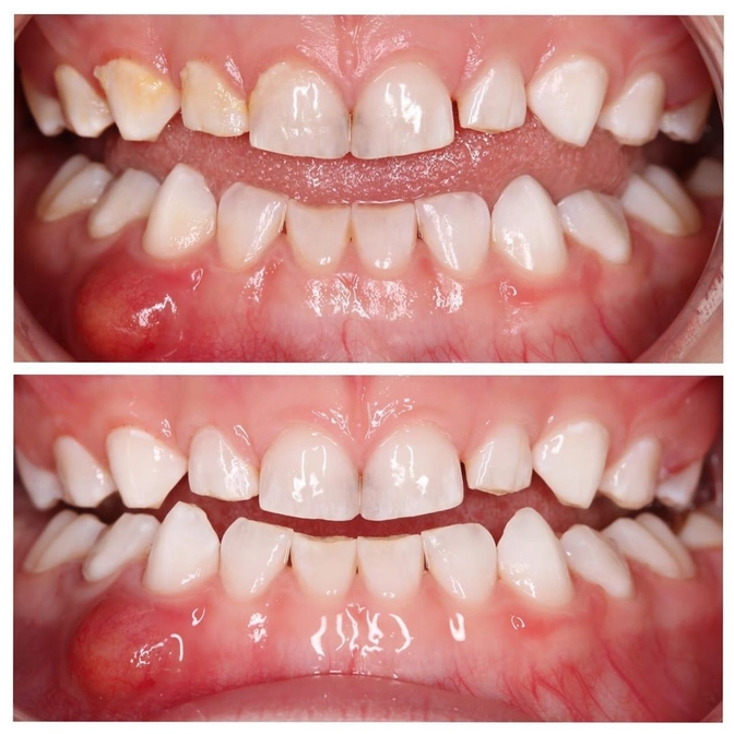 Комплекс проблем в молочном прикусе 