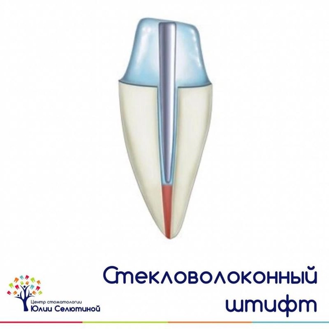 Стекловолоконный штифт: показания и преимущества.