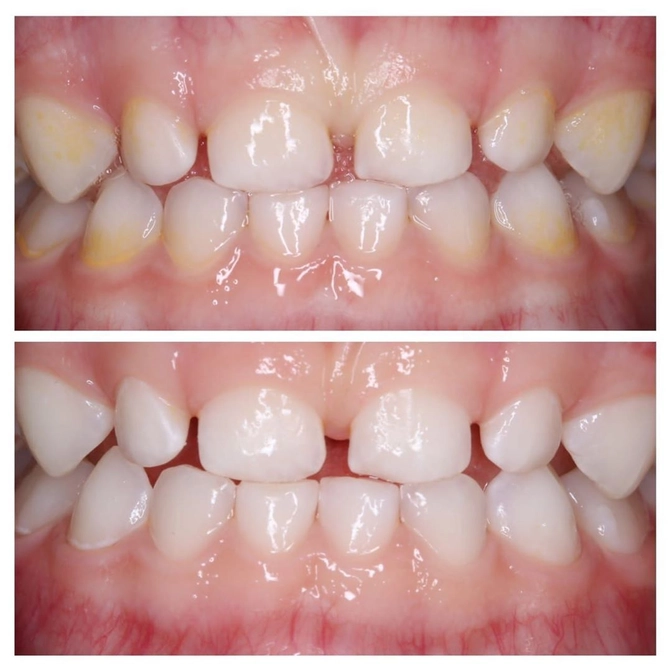 Налет после приема антибиотиков: повод показаться стоматологу.