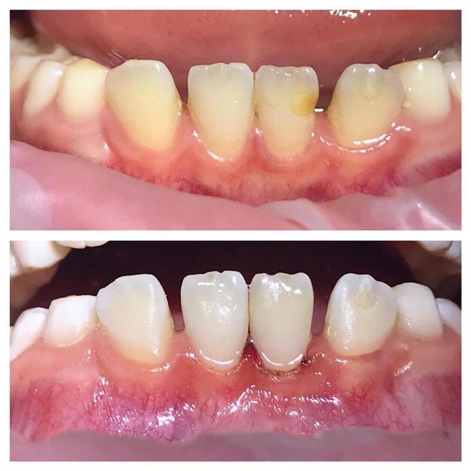 Гипоплазия эмали постоянных зубов.