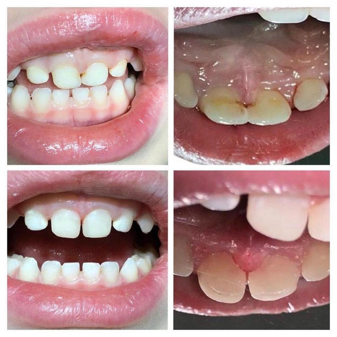 Реставрация центральных зубов.