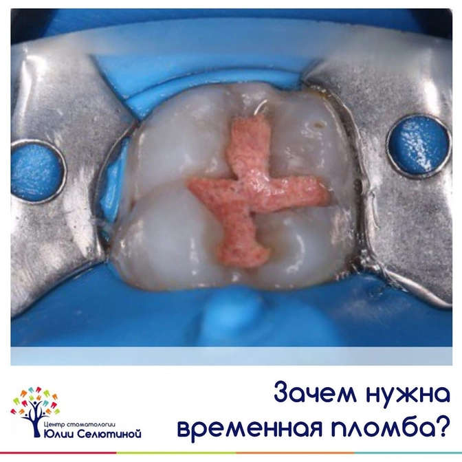 Зачем нужна временная пломба? 
