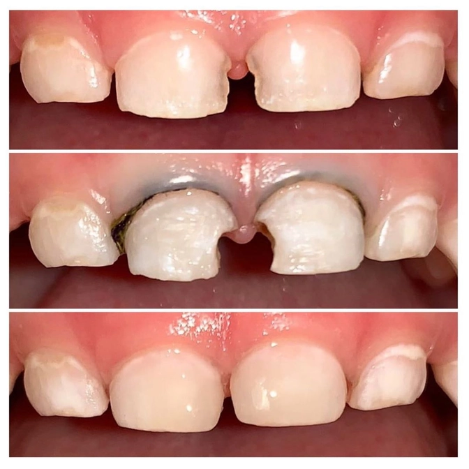 Реставрация центральных молочных зубов.