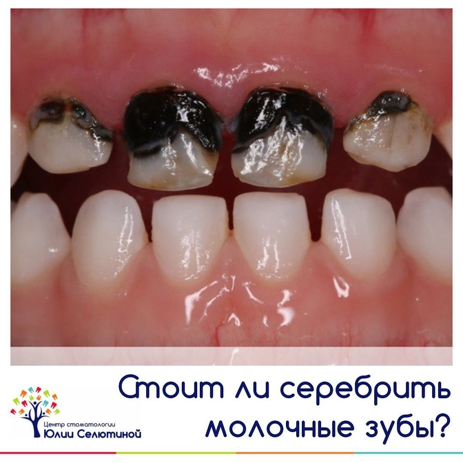 Стоит ли серебрить молочные зубы? 