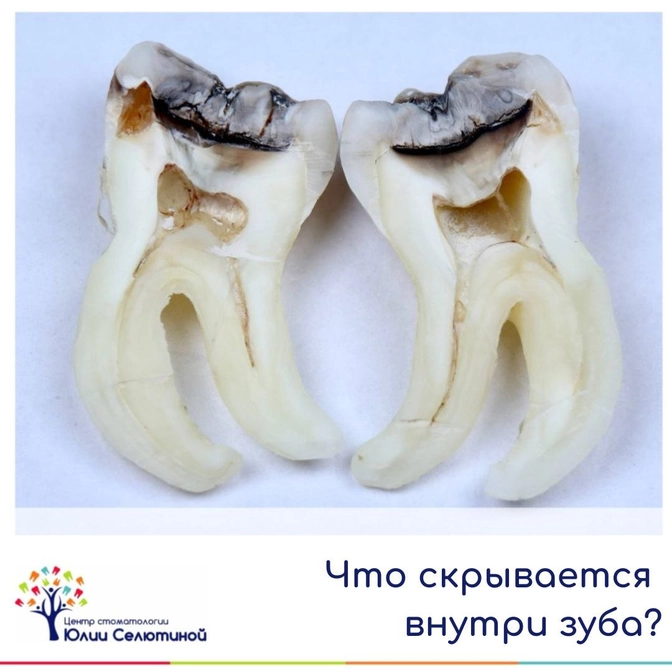Что скрывается внутри зуба?