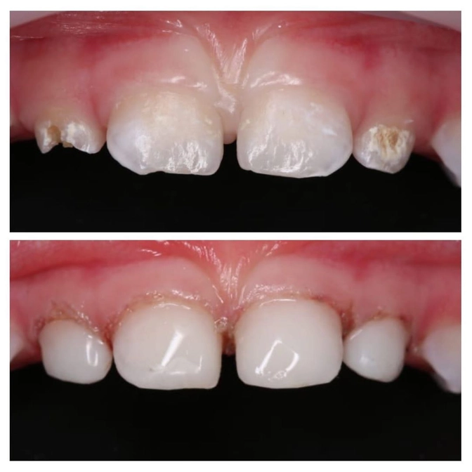 Лечение кариеса под наркозом 