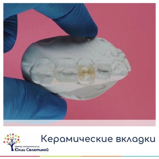 Всё о керамических вкладках 