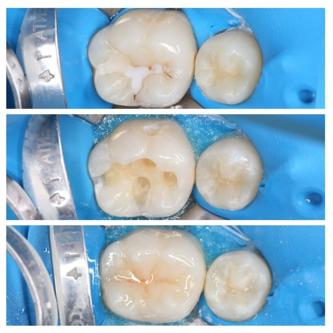 Пломба и реставрация - в чем разница? 
