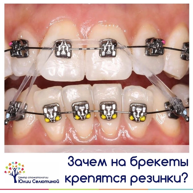 Для чего на брекетах нужны "резинки"?