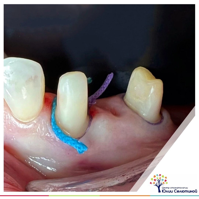 Что такое "ретракция"? 