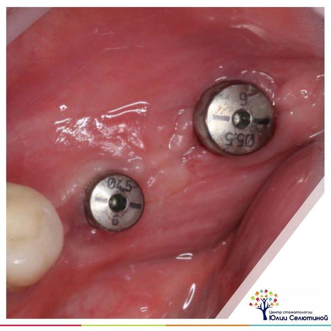 Формирователь десны: что это?