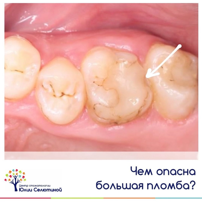 Чем опасна большая пломба? 