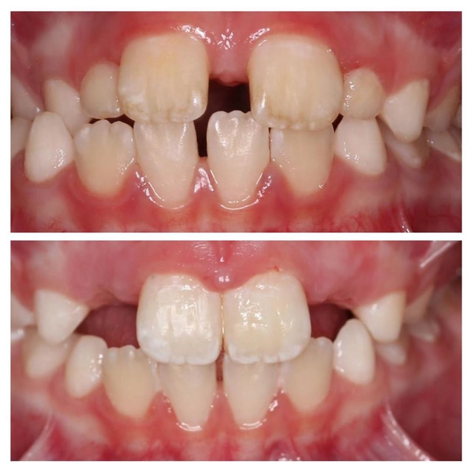 Ортодонтическое лечение у подростка 