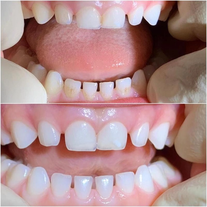 Как часто проводить профессиональную гигиену детям?