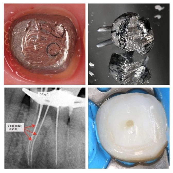 Клинический случай: перелечивание зуба с "кистой"