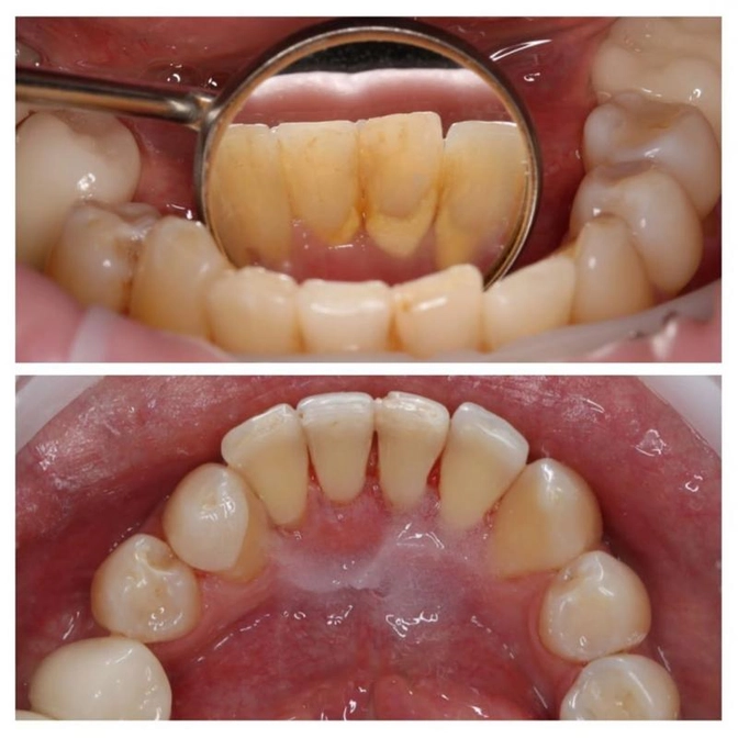 Как часто проводить гигиену полости рта?