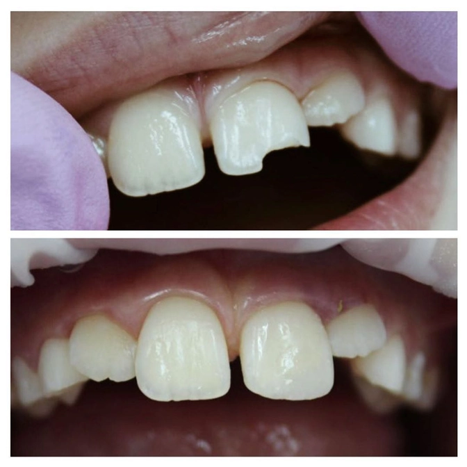 Скол постоянного зуба у ребёнка: всегда ли необходимо восстановление?