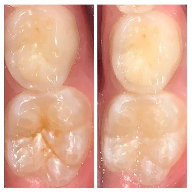 Герметизация фиссур - профилактика кариеса. 