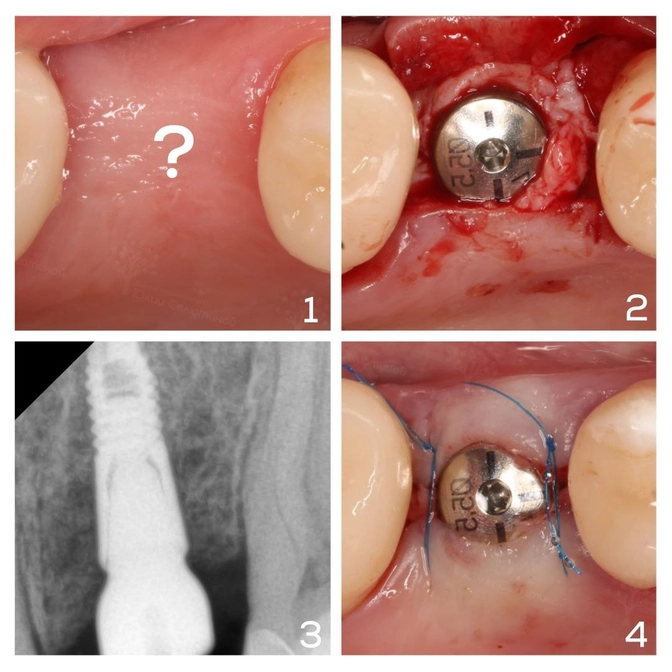 Для чего делается пластика десны?